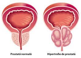 Spre marea noastră surpriză, prostata mea îşi recăpătase, aproape, dimensiunile normale şi am hotărât să anulăm operaţia. Prostata MÄƒritÄƒ De Volum RecomandÄƒri È™i Tratament
