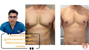 Image result for Gynecomastia