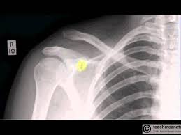 Image result for Shoulder XRay