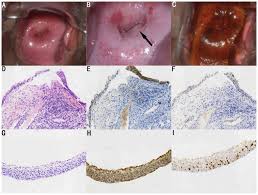 Image result for Colposcopy Findings