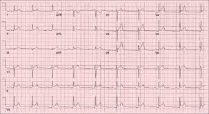 Image result for Pericarditis