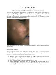 L41.0 pityriasis lichenoides et varioliformis acuta; Jurnal Pitiriasis Alba Skin Medicine