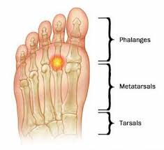 Image result for Metatarsalgia