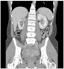 Image result for Genitourinary Tuberculosis