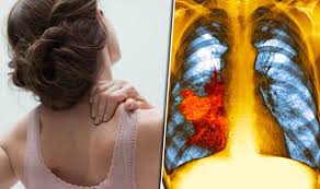 The pain can spread to your upper back, between your shoulder blades, and your arm as the tumor grows. Shoulder Pain Lung Cancer Symptoms Include Arm Ache Express Co Uk