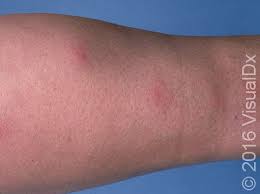Image result for erythema nodosum