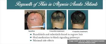 Three columbia specialties — dermatology, ophthalmology, and otolaryngology — are taking up residence in our expanded east side location at 880 3rd avenue. Drug For Alopecia Areata Could Bid Good Bye For Hair Loss And Baldness