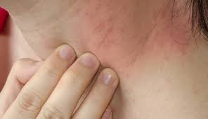 Tips For Avoiding Allergic Reactions To Nickel Clinical Advisor