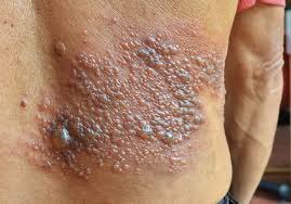 Image result for shingles