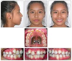 My 9 y/o just had an expander placed in the roof of his mouth yesterday as the beginning of some orthodontic work. A Tissue And Boneborne Rapid Palatal Expander Jco Online Journal Of Clinical Orthodontics
