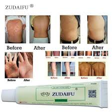 Medical term synonyms, medical term pronunciation, medical term translation, english dictionary definition of medical term. Krim Ajaib Ezcema Psoriasis Panau Gatal Kurap
