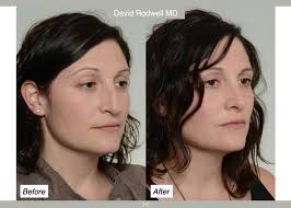 This is defnitely one of my favorite rhinoplasty transformations.  Rhinoplasty surgery is incredibly complex and difficult to predict, but  it's precisely that challenge and the ability to provide such far-reaching  positive impacts