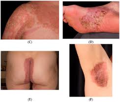 Image result for psoriasis