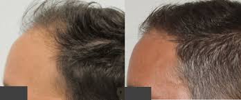 We did not find results for: How Long Does Hair Regrowth Take