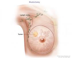 3 jul 2015 23:14 in response to kimchoson. Breast Cancer Treatment Options Virginia Oncology