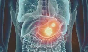 Image result for Potassium Competitive Acid Blocker