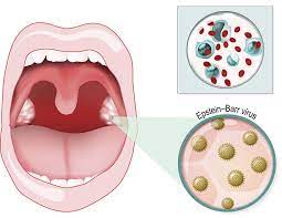 What Is Mononucleosis? Symptoms, Diagnosis, & Treatment