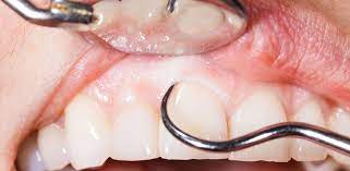 International recognition · scholarly articles · widely indexed Gum Swelling After Root Canal Root Canal Gum Swelling Menyc