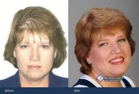 From the beginning of time, hair has been regarded as one's crowning glory. Female Pattern Baldness A Closer Look Pai Hair Restoration Mclean Virginia