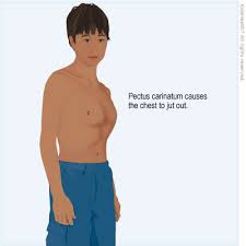 But not but i wouldnt say it was an emergency because its not painful but im worrying now. Chest Wall Disorder Pectus Carinatum For Parents Nemours Kidshealth