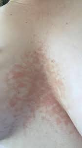 Image result for heat rash under breasts