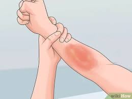 Check spelling or type a new query. How To Take The Sting Out Of A Burn With Pictures Wikihow