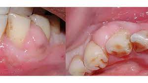 To treat and relieve the mouth of the pain caused by the boils, you can gargle with tea tree oil. Gum Abscess Pictures Treatment Symptoms Causes And More