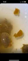 Image result for yellow stool human poop