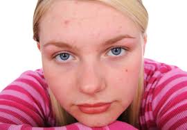 Image result for acne face
