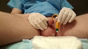 Insert catheter after saline inflation