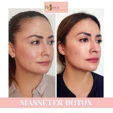 How long does botox last in the jaw line? Rejuva Pampanga Masseter Botox Botox Injection Into Facebook