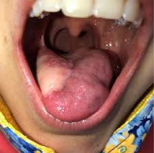 Image result for cancer of tongue