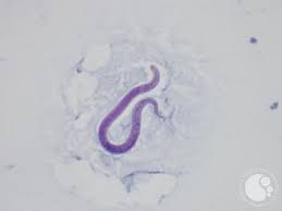 Image result for Strongyloides