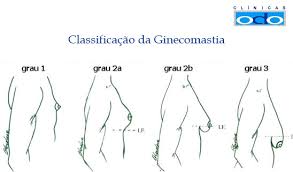 Resultado de imagem para Ginecomastia