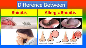 Image result for Allergic Rhinitis