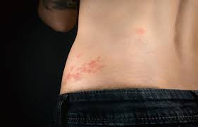 Image result for shingles