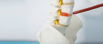 The recurrent dislocation of the temporomandibular joint leading to difficulty in closing the mouth, an emergency, managed by manual reduction followed by. How Do You Know If You Have A Herniated Disc Healthquest Pt