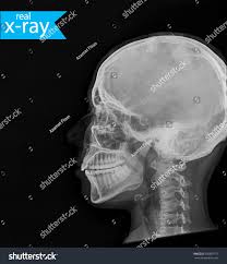 Image result for Skull XRay