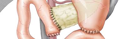Mysurgery Pankreaskarzinom