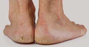 Tapak kaki terlihat sangat jelas dan ukurannya sangat besar bahkan jika ada cekungan tapak kaki tersebut mereka saling berkejaran di tengah laut hingga sampai di tempat pertapaan tuan tapa. Alami Tumit Kaki Merekah Jangan Abaikan Sahaja Ini Cara Merawatnya