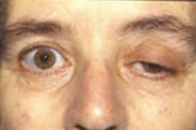 Ptosis Adalah Tanda Penyebab Gejala Cara Mengobati Honestdocs
