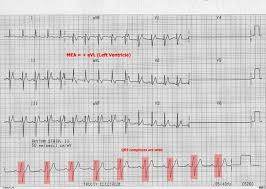Image result for Bundle Branch Block