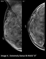 Maybe you would like to learn more about one of these? Your Patient Got A Dense Breast Notification With Her Mammogram Report What Are You Supposed To Do Christianacare News