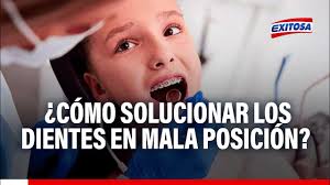 🔴🔵 ¿Cómo solucionar los dientes en mala posición? Experto responde
