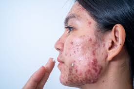 Image result for acne face