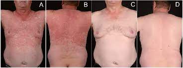 Methotrexate Treatment For Pityriasis Rubra Pilaris A Case Series And Literature Review Html Acta Dermato Venereologica