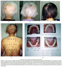 Sell custom creations to people who love your style. How To Treat Metal Hypersensitive Alopecia Areata And Atopic Alopecia Scitechnol