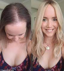 I started using a pill called diane 35 and the results at my skin were amazing. Woman 33 Reveals How She Lost 70 Per Cent Of Her Hair After Switching Contraceptive Pill Daily Mail Online
