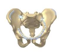 Mantaro Pelvic Plates Online - Madison Ortho