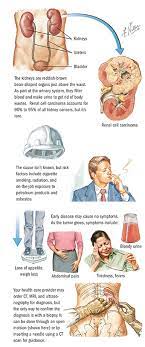 The symptoms of kidney cancer appear in places like your urine or lower back. Kidney Cancer Spectrum Health